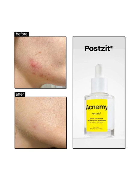 Acnemy Postzit Serum Corrector Marcas Post-Espinillas Сыворотка от высыпаний
