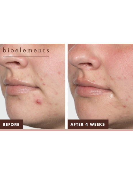 Bioelements Daily Meds Сироватка з кислотами та ніациномідом для лікування акне
