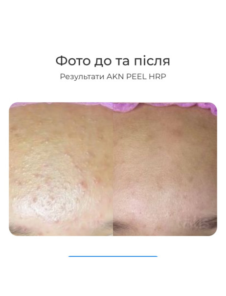 Innoaesthetics INNO-DERMA HRP AKN Peel HRP Домашній пілінг для проблемної шкіри