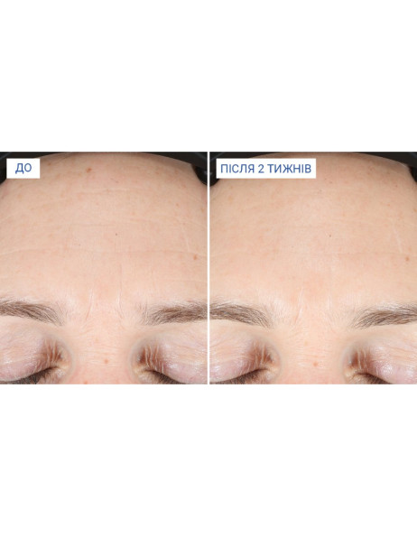 iS Clinical Extra Strength Active Peel Brightening System Пілінг-система для освітлення, оновлення та зменшення зморшок