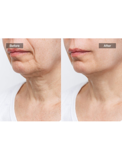 Jovs Skincare Neck LED Mask Маска для шиї та декольте із лазерною терапією
