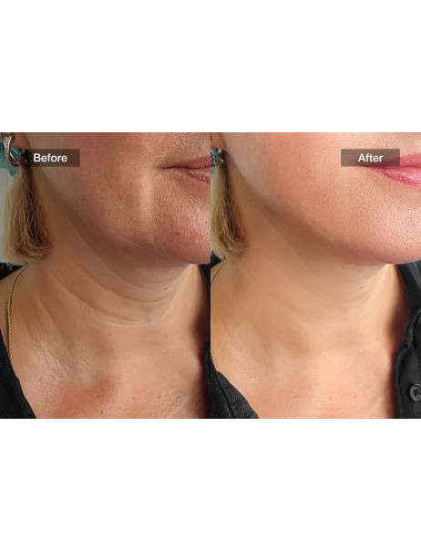 Jovs Skincare Neck LED Mask Маска для шиї та декольте із лазерною терапією