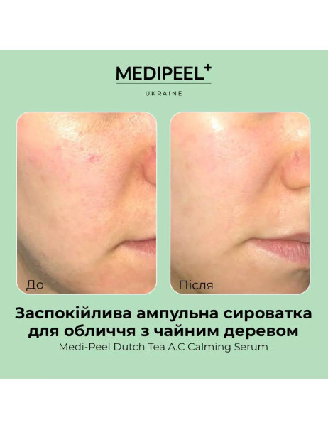 Medi-Peel Dutch Tea A.C Calming Serum Заспокійлива сироватка