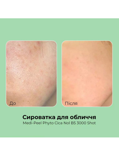 Medi-Peel Phyto Cica-Nol B5 3000 Shot Serum Пілінг-сироватка зі спікулами та центелою