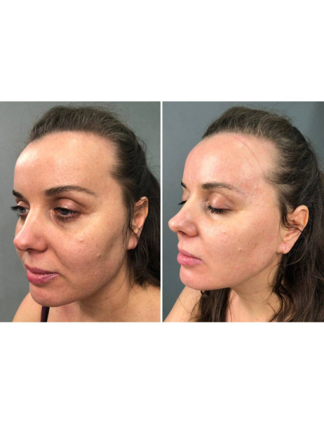 Medica+ Skin Lifting 6.0 Pink (Japan) Мікрострумовий ліфтинг-масажер для обличчя