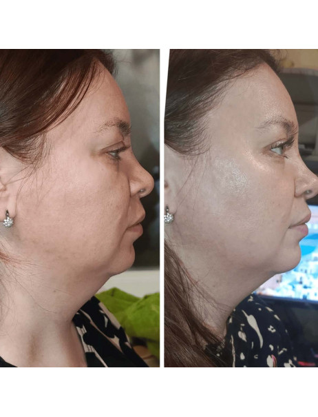 Medica+ Skin Lifting 7.0 Pink EMS, LED (Japan) Мікрострумовий ліфтинг-масажер для обличчя