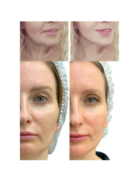 Medica+ Skin Lifting 7.0 White EMS, LED (Japan) Мікрострумовий ліфтинг-масажер для обличчя