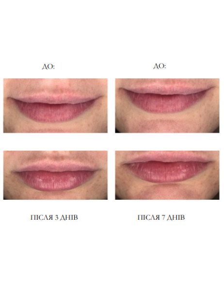 Monika Heiligmann Non Invasive Lip-Volumizer NHFT-10 Неинвазивный лип-волюмайзер (1 блистер)