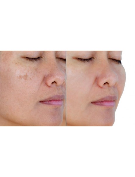 Perricone MD Vitamin C Ester Intensive Dark Spot Treatment Осветляющая сыворотка для лица